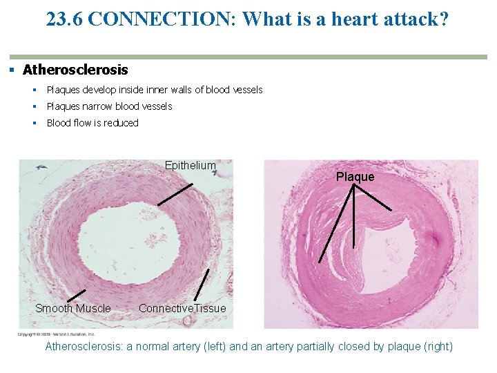 23. 6 CONNECTION: What is a heart attack? § Atherosclerosis § Plaques develop inside