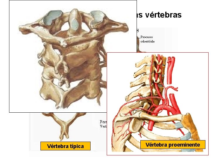 Características regionais das vértebras cervicais Vértebra típica Vértebra proeminente 