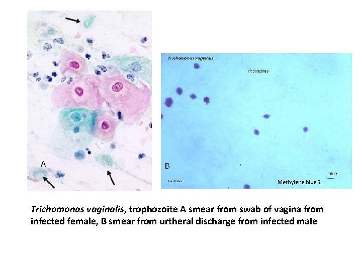 A B Methylene blue S. Trichomonas vaginalis, trophozoite A smear from swab of vagina