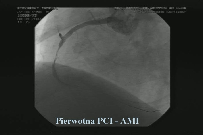 Pierwotna PCI - AMI 