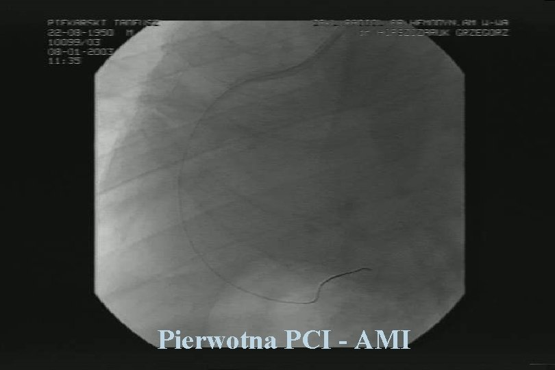 Pierwotna PCI - AMI 