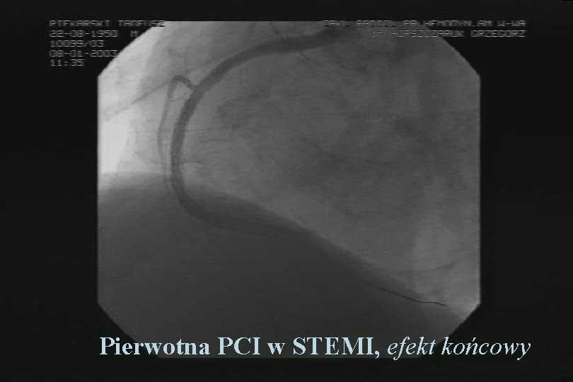 Pierwotna PCI w STEMI, efekt końcowy 