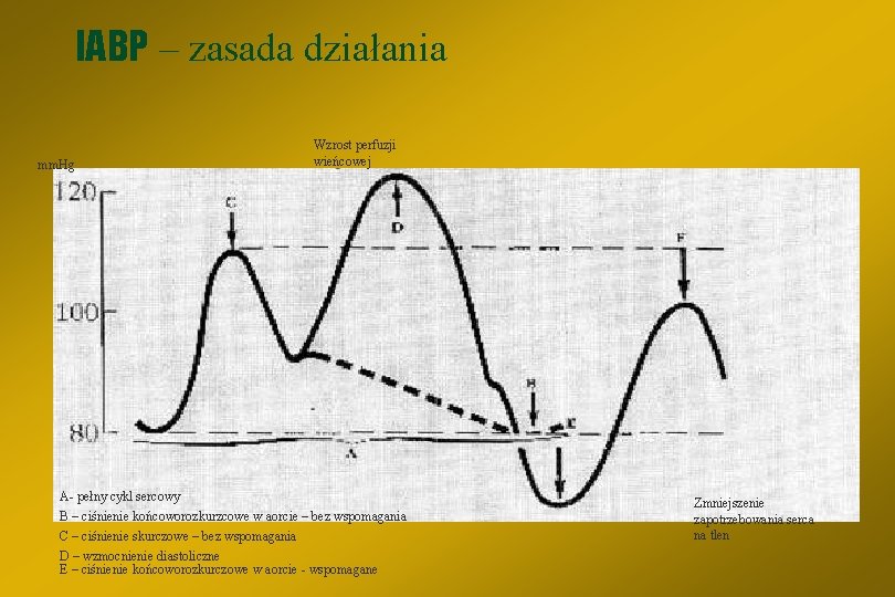 IABP – zasada działania mm. Hg Wzrost perfuzji wieńcowej A- pełny cykl sercowy B