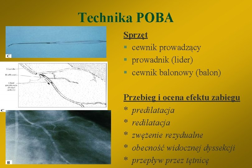 Technika POBA Sprzęt § cewnik prowadzący § prowadnik (lider) § cewnik balonowy (balon) Przebieg