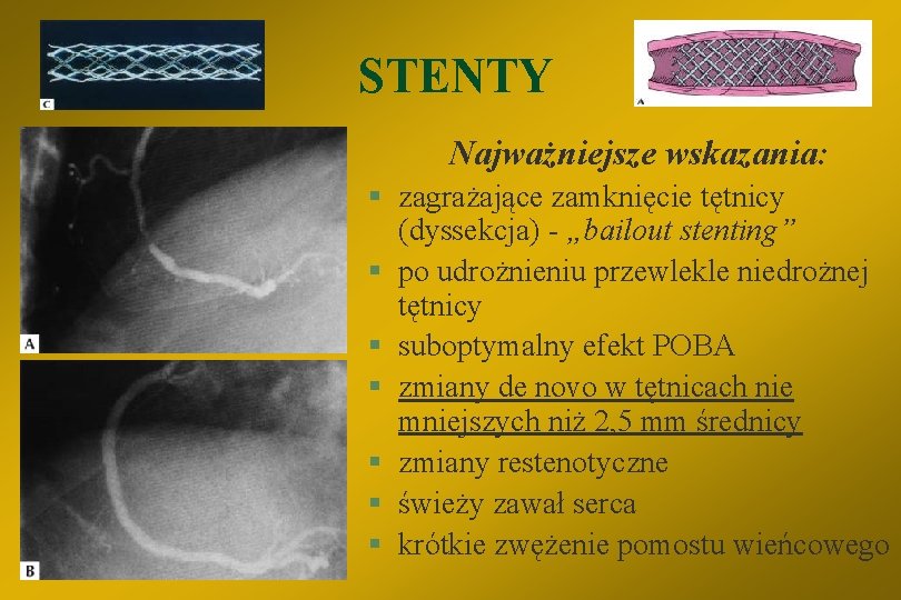 STENTY Najważniejsze wskazania: § zagrażające zamknięcie tętnicy (dyssekcja) - „bailout stenting” § po udrożnieniu
