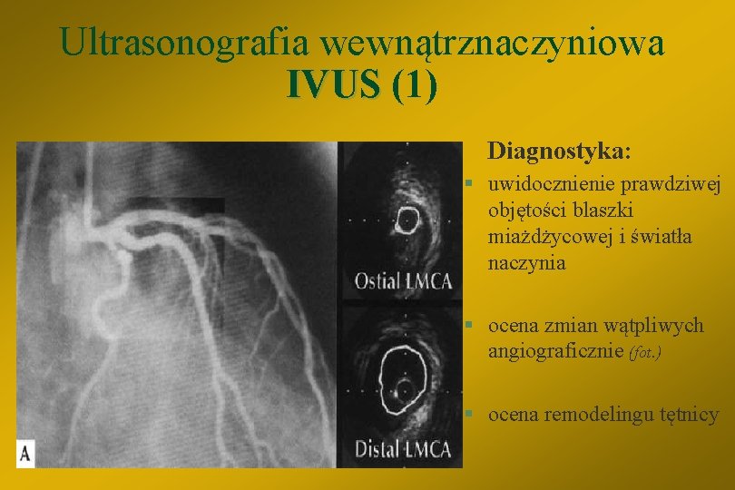 Ultrasonografia wewnątrznaczyniowa IVUS (1) Diagnostyka: § uwidocznienie prawdziwej objętości blaszki miażdżycowej i światła naczynia