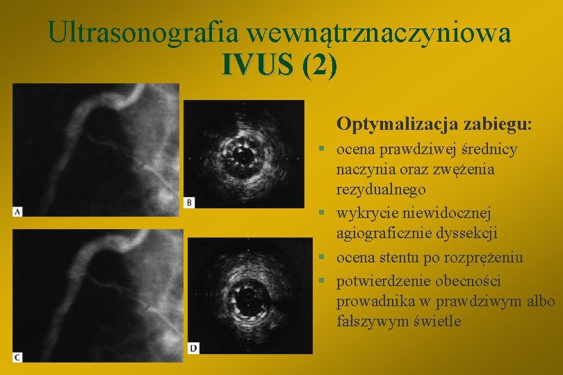 Ultrasonografia wewnątrznaczyniowa IVUS (2) Optymalizacja zabiegu: § ocena prawdziwej średnicy naczynia oraz zwężenia rezydualnego