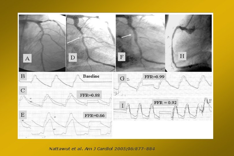 Nattawut et al. Am J Cardiol 2005; 96: 877– 884 