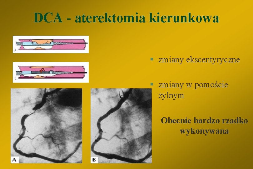 DCA - aterektomia kierunkowa § zmiany ekscentyryczne § zmiany w pomoście żylnym Obecnie bardzo