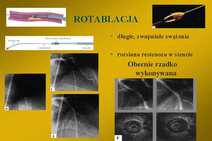 ROTABLACJA ROTA § długie, zwapniałe zwężenia § rozsiana restenoza w stencie Obecnie rzadko wykonywana