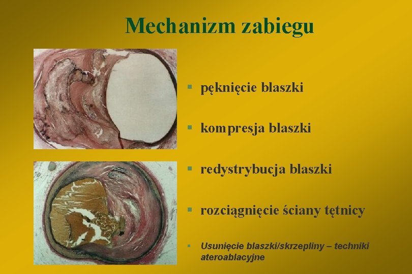 Mechanizm zabiegu § pęknięcie blaszki § kompresja blaszki § redystrybucja blaszki § rozciągnięcie ściany