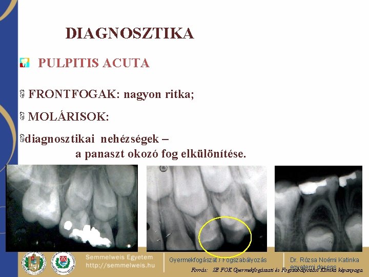 DIAGNOSZTIKA PULPITIS ACUTA FRONTFOGAK: nagyon ritka; MOLÁRISOK: diagnosztikai nehézségek – a panaszt okozó fog