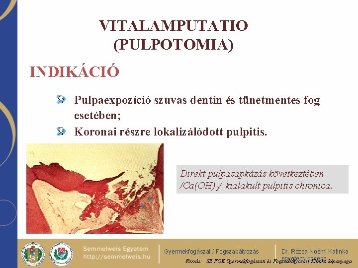 VITALAMPUTATIO (PULPOTOMIA) INDIKÁCIÓ Pulpaexpozíció szuvas dentin és tünetmentes fog esetében; Koronai részre lokalizálódott pulpitis.