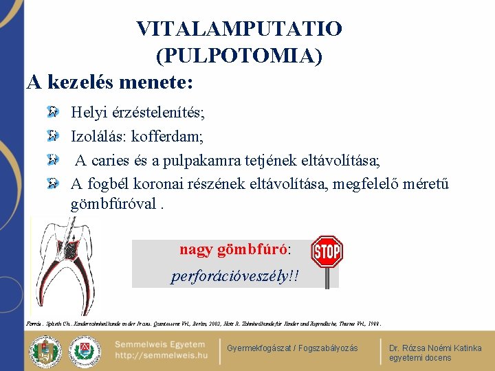 VITALAMPUTATIO (PULPOTOMIA) A kezelés menete: Helyi érzéstelenítés; Izolálás: kofferdam; A caries és a pulpakamra