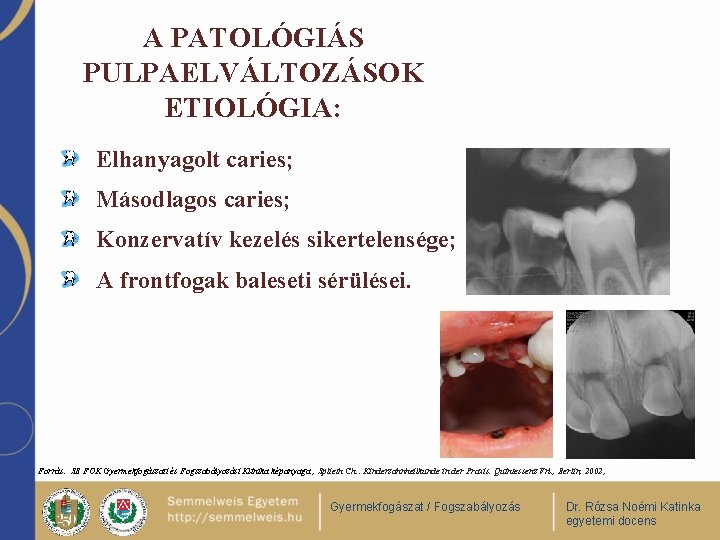 A PATOLÓGIÁS PULPAELVÁLTOZÁSOK ETIOLÓGIA: Elhanyagolt caries; Másodlagos caries; Konzervatív kezelés sikertelensége; A frontfogak baleseti