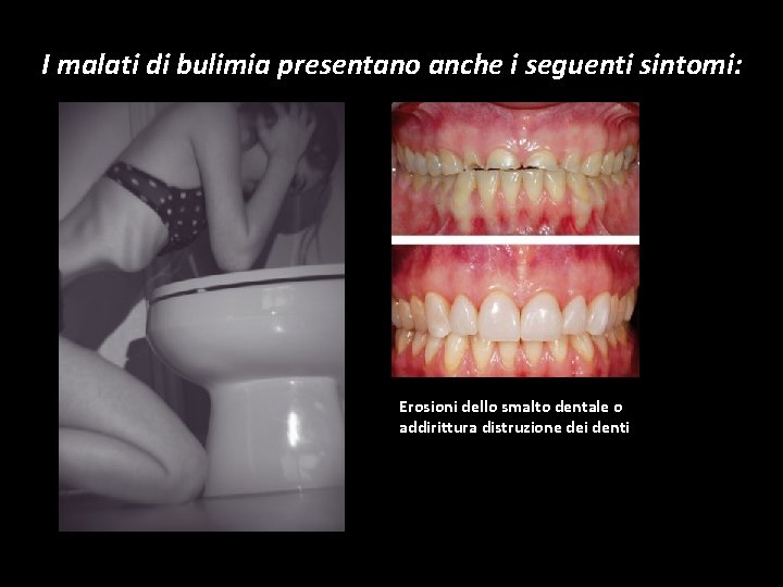 I malati di bulimia presentano anche i seguenti sintomi: Erosioni dello smalto dentale o