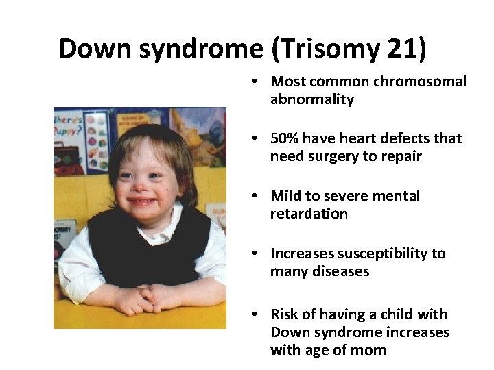 Down syndrome (Trisomy 21) • Most common chromosomal abnormality • 50% have heart defects