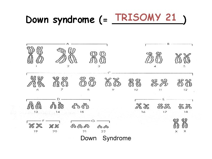 TRISOMY 21 Down syndrome (= ______) 