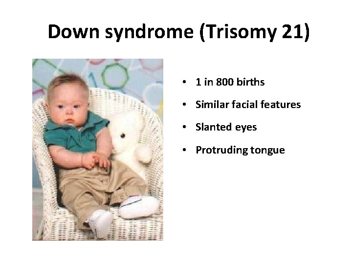 Down syndrome (Trisomy 21) • 1 in 800 births • Similar facial features •