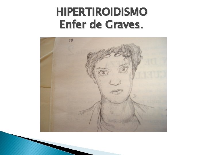 HIPERTIROIDISMO Enfer de Graves. 