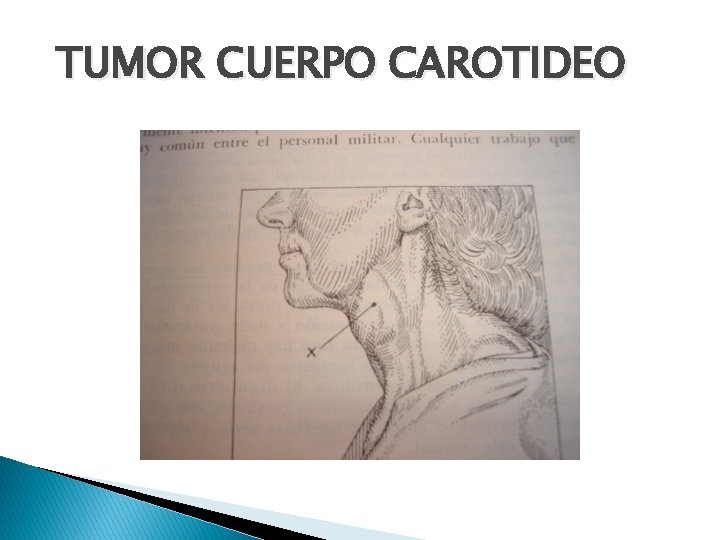 TUMOR CUERPO CAROTIDEO 