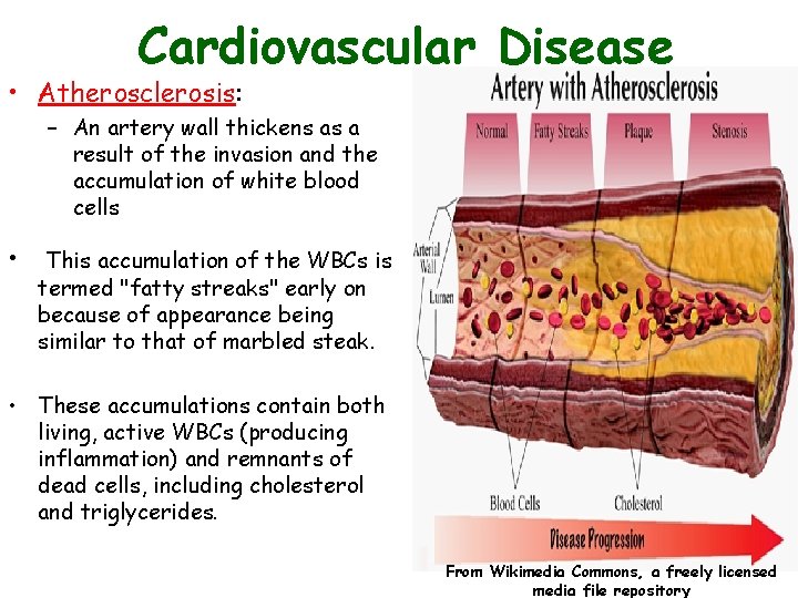 Cardiovascular Disease • Atherosclerosis: – An artery wall thickens as a result of the