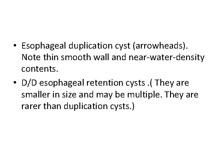  • Esophageal duplication cyst (arrowheads). Note thin smooth wall and near-water-density contents. •