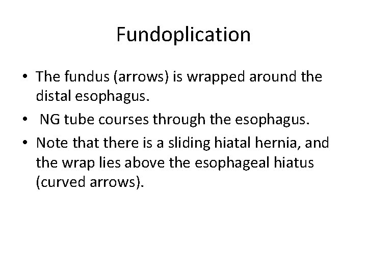 Fundoplication • The fundus (arrows) is wrapped around the distal esophagus. • NG tube