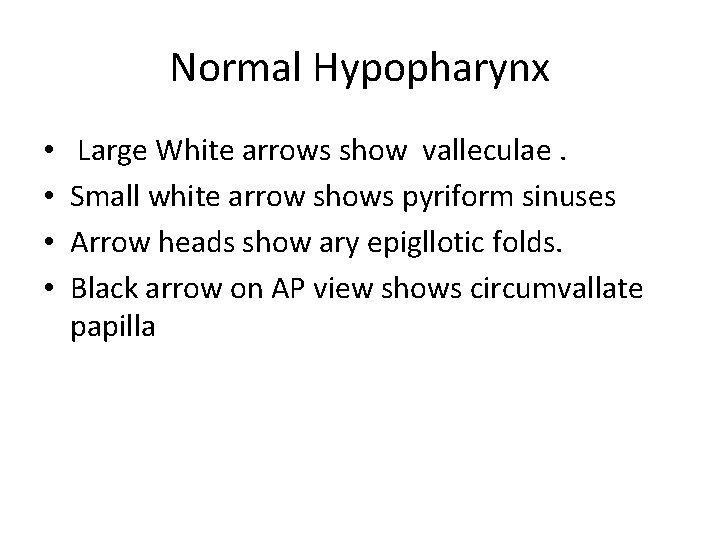 Normal Hypopharynx • • Large White arrows show valleculae. Small white arrow shows pyriform