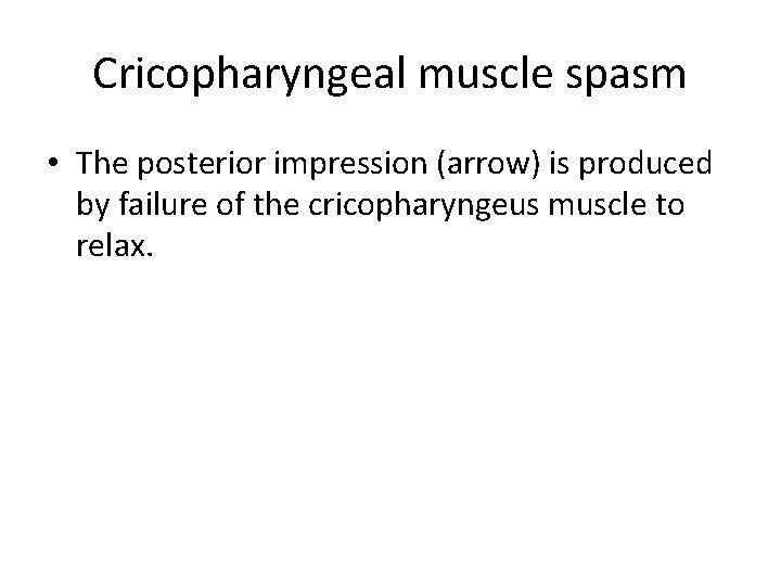 Cricopharyngeal muscle spasm • The posterior impression (arrow) is produced by failure of the