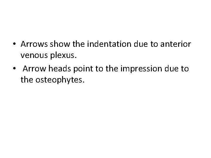  • Arrows show the indentation due to anterior venous plexus. • Arrow heads