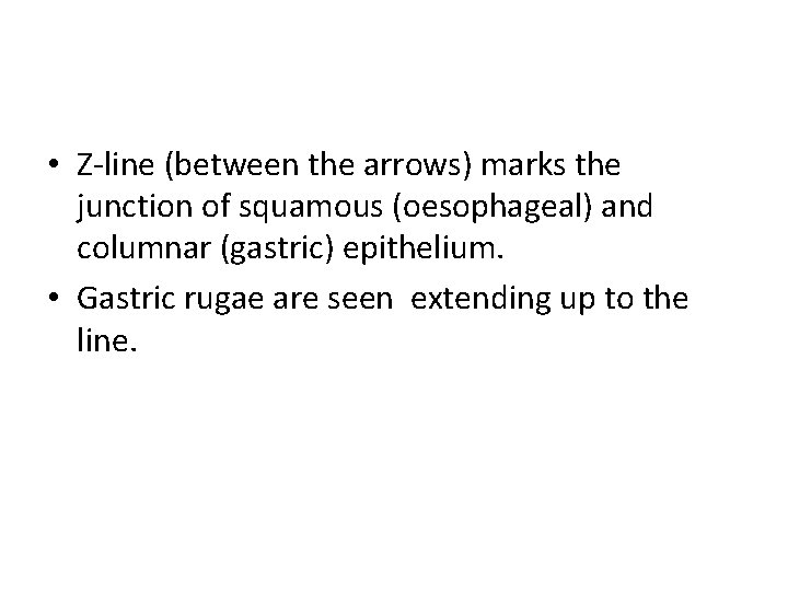  • Z-line (between the arrows) marks the junction of squamous (oesophageal) and columnar