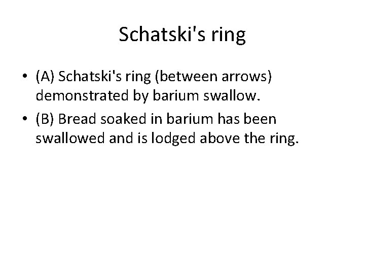 Schatski's ring • (A) Schatski's ring (between arrows) demonstrated by barium swallow. • (B)