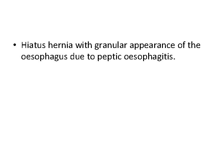  • Hiatus hernia with granular appearance of the oesophagus due to peptic oesophagitis.