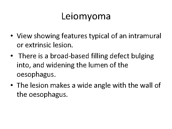 Leiomyoma • View showing features typical of an intramural or extrinsic lesion. • There