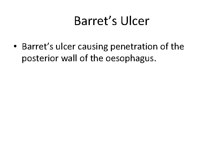 Barret’s Ulcer • Barret’s ulcer causing penetration of the posterior wall of the oesophagus.