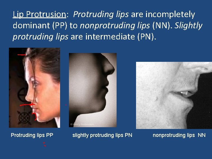 Lip Protrusion: Protruding lips are incompletely dominant (PP) to nonprotruding lips (NN). Slightly protruding