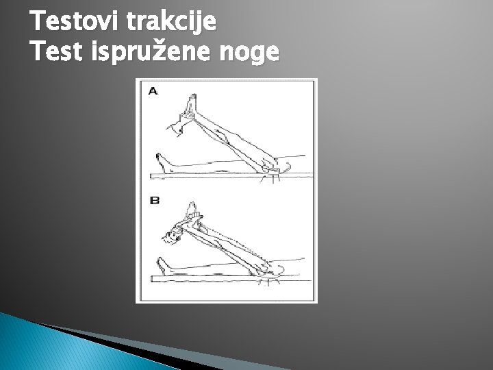 Testovi trakcije Test ispružene noge 