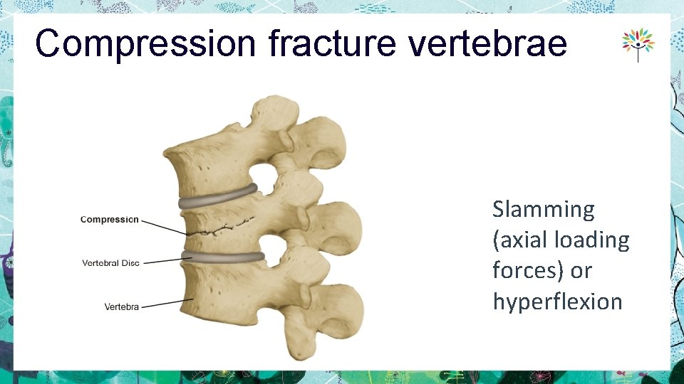 Compression fracture vertebrae Slamming (axial loading forces) or hyperflexion 