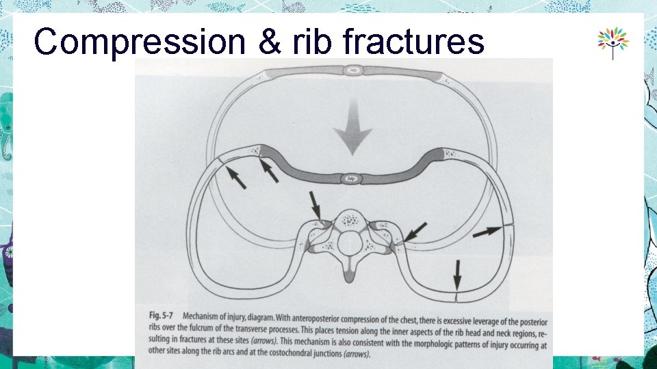 Compression & rib fractures 