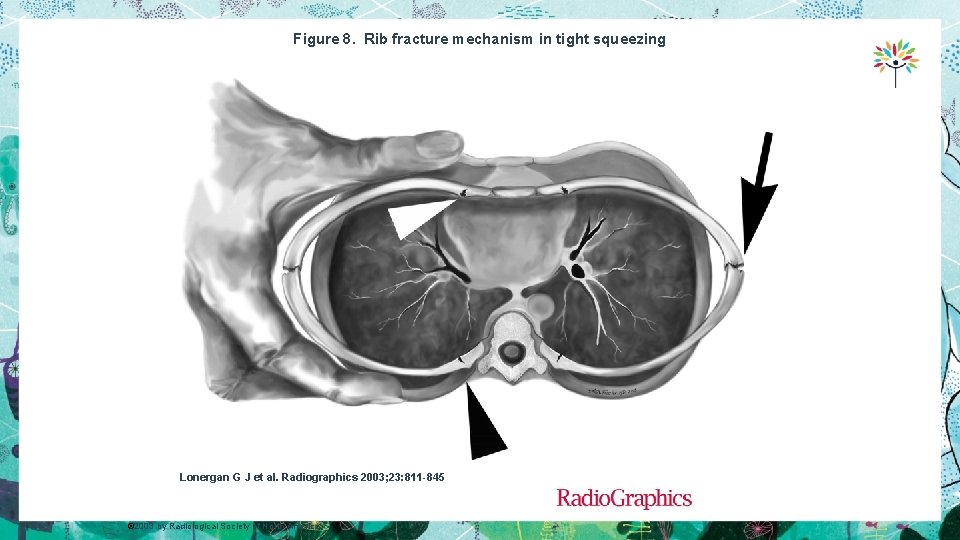 Figure 8. Rib fracture mechanism in tight squeezing Lonergan G J et al. Radiographics