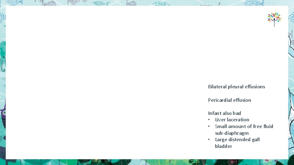 Bilateral pleural effusions Pericardial effusion Infant also had • Liver laceration • Small amount