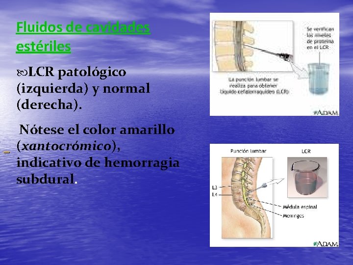 Fluidos de cavidades estériles LCR patológico (izquierda) y normal (derecha). Nótese el color amarillo