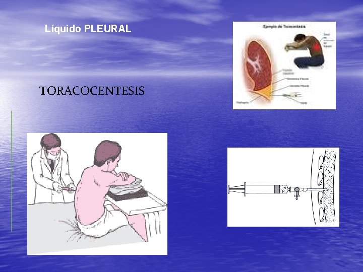 Líquido PLEURAL TORACOCENTESIS 