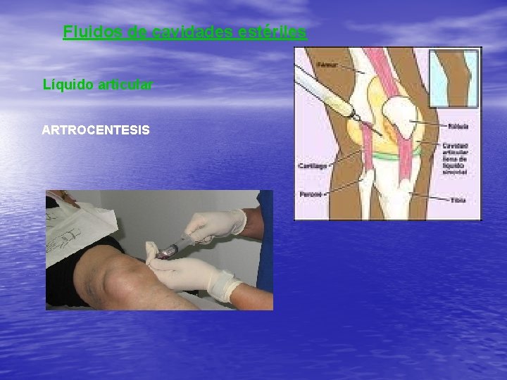 Fluidos de cavidades estériles Líquido articular ARTROCENTESIS 