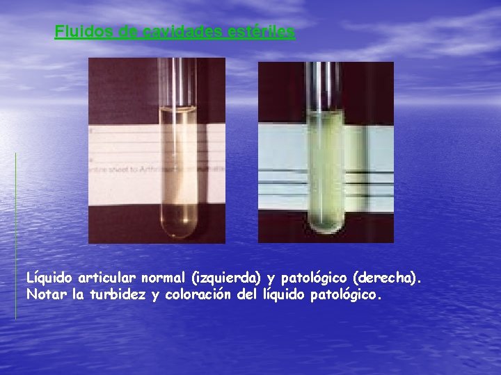 Fluidos de cavidades estériles Líquido articular normal (izquierda) y patológico (derecha). Notar la turbidez