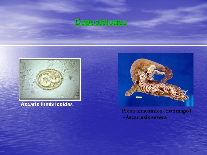 Deposiciones Ascaris lumbricoides Pieza anatómica (estómago) –Ascariasis severa 