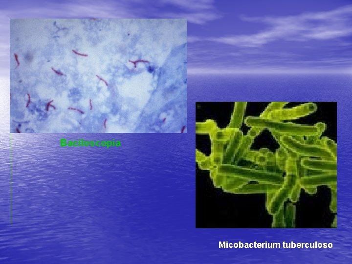 Baciloscopia Micobacterium tuberculoso 