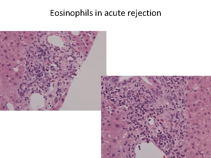 Eosinophils in acute rejection 