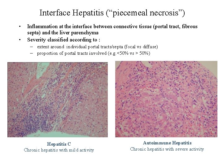 Interface Hepatitis (“piecemeal necrosis”) • • Inflammation at the interface between connective tissue (portal